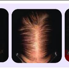 Thick, radiant hair is a symbol of beauty and femininity. Pdf Antiandrogen Therapy For Androgenetic Alopecia