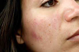 Welke pil werkt goed tegen acne. Is Dit De Snelste Oplossing Tegen Pigmentvlekken Tot Nu Toe Beautylab Nl