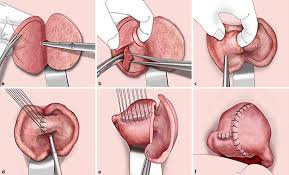 Adenomyose is een medische aandoening die wordt gekenmerkt door de groei van cellen die zich aan de binnenkant van de. Figure 6 Adenomyose Springerlink