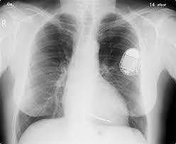 How does an implantable cardioverter defibrillator work? how will a pacemaker affect my lifestyle? File Herzschrittmacher Auf Roentgenbild Jpg Wikimedia Commons