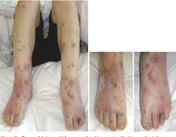 Symptoms of meningococcemia (i.e., blood infection) include acute onset of fever often accompanied by hypotension and shock, and may include a petechial or purpuric rash, purpura fulminans, and multiorgan failure. Figure 1 From Meningococcemia Without Meningitis In Japan Semantic Scholar