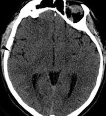 Cerebral venous thrombosis (cvt) refers to occlusion of venous channels in the cranial cavity, including dural venous thrombosis, cortical vein although not used routinely in clinical practice, whole brain ct perfusion may assist in establishing the diagnosis of cvt by detecting perfusion. Cerebral Venous Thrombosis And Multidetector Ct Angiography Tips And Tricks Radiographics