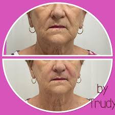 Nurse Trudy Muller 💉 (@skinulove) • Instagram photos and videos