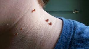 Una descripción general de esta enfermedad, sus síntomas, tratamiento y como prevenir su contagio. Negii Genitali De Ce Apar E I Cum Se TrateazaÆ' Corect Cauterizarea Verucilor Genitale La BÄƒrbaÈ›i