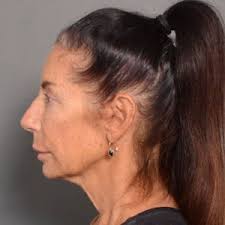 Santa Barbara, CA Neck Lift