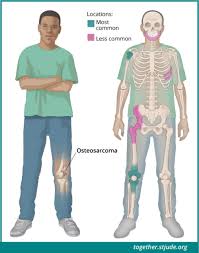 These symptoms are infrequent among people who are having. Osteosarcoma In Children And Teens Together