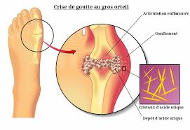 Il existe trois types de cancer primaire des os : Goutte Que Faire En Cas De Crise