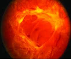 You should plan to make regular eye doctor visits when you have diabetes.high blood sugar can lead to problems like blurry vision, cataracts, glaucoma, and retinopathy.in fact, diabetes is. Advanced Diabetic Retinopathy With Retinal Glyosis Download Scientific Diagram