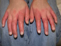 It is a chronic papulosquamous disorder of unknown etiology characterized by reddish orange scaly. 83 Pityriasis Rubra Pilaris Plastic Surgery Key