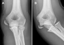 There were eight male and five female patients. Nonoperative Medial Epicondyle Humeral Fracture Care Slightly Better Than Surgery