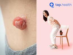 Image result for Hemorrhoid