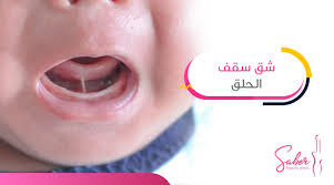علاج شق سقف الحلق بأفضل الطرق 2020 دكتور صابر عبد المقصود