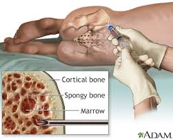 Medical illustration of bone marrow aspiration and biopsy at the posterior iliac crest, with inset showing cortical bone, spongy bone, and marrow