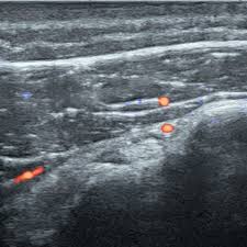 Image result for Biceps Tendon Injection