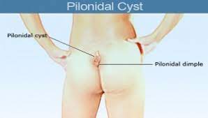 86 ($14.86/count) get it as soon as wed, aug 4. Pilonidal Cyst Symptoms Treatments Surgery