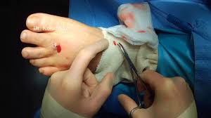 Removing a splinter or glass in a foot or hand without painmy son has a piece of glass in his foot from a bottle of hot sauce that he broke in th. Glass In Foot Youtube