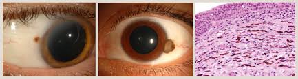 Image result for conjunctival melanoma