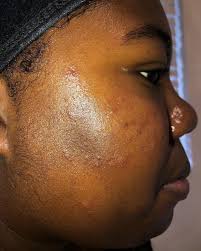 Isha Taylor PA-C, Esthetician (@skindeep_by_isha) • Instagram photos and  videos