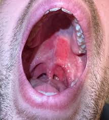 Image result for Canker sores symptoms roof of the mouth
