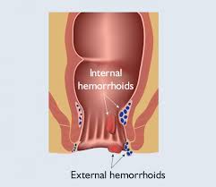 Image result for hemoroid human