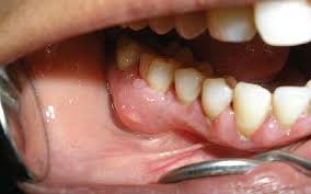 Image result for periostitis