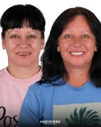 Dental Implant Treatment in Turkey with Lando's Smile