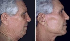 Chirurgie esthétique: techniques light pour un coup de jeune 2/2