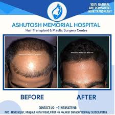 I am currently taking dr batra's treatment for hair loss in aundh pune. Is There Any Good Hair Loss Treatment Doctor In Patna Quora