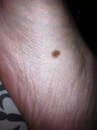 However, the cancer hasn't spread yet. Skin Cancer Cancer Chat