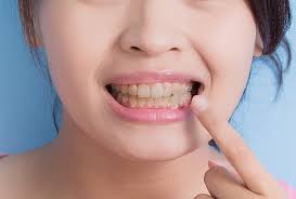 Home Remedies For Yellow Teeth Art Of Smiles