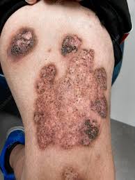 Image result for Pyoderma Gangrenosum