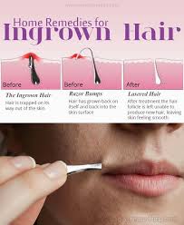 In addition, topical antibiotics and antiseptics are also effective in reducing bacteria on the skin, thereby promoting healing. Home Remedies For Ingrown Hair Treat Ingrown Hair Ingrown Hair Ingrown Leg Hair