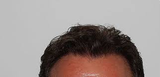 Scopri come ridurre il costo. Prima E Dopo Il Trapianto Capelli Fue Hair Clinic Biorigeneral