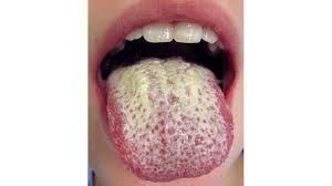 Image result for oral thrush symptoms roof of the mouth