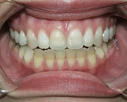 See full list on wikihow.com Long Term Use Of 6 5 Hydrogen Peroxide Bleaching Strips On Tetracycline Stain A Clinical Study Volume 32 Issue 8 Compendium