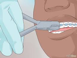Getting use to the braces, however, could take a little longer, so patients should expect to feel strange for the glue will be scraped off of your teeth. How To Prepare For Getting Braces Removed Getting Braces Braces Tips Teeth After Braces