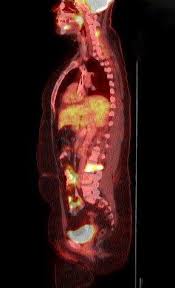 It usually takes between 30 and 60 minutes. Breast Cancer Staging Physiology Trumps Anatomy