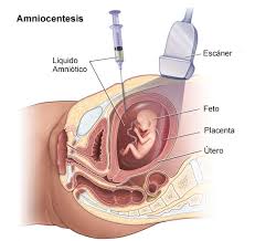 Baña la cavidad amniótica y al feto. Amniocentesis