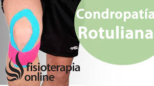 Kinesiotape Para La Condropatia O Condromalacia Rotuliana Condromalacia Rotuliana Condromalacia Tendinitis Rotuliana