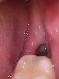 We did not find results for: 6 Days Post Op Possibly Dry Socket Not Sure If I M Being Paranoid Or Not But I Still Have Dull Pain Mainly On My Left Side Nothing Crazy Though I Ve Been