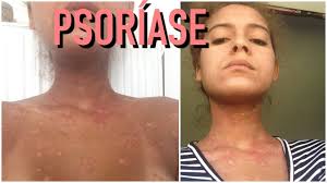 São de uso externo , ou seja, actuam quando aplicados na parte. Minha Luta Contra A Psoriase Mari Morena Youtube