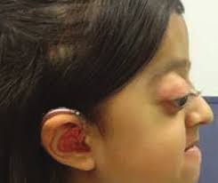 Pearls for Putting an IOL in the Sulcus P. 22 Indications for Refractive  Surgery in Children P. 34 Non-femtosecond Methods for C