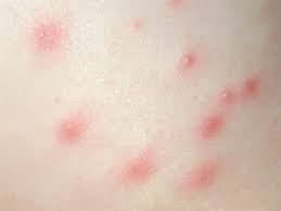 The entrance of the bacteria into the skin that has been breached by the hair marks the start of the infection in the ingrown hair at the hair follicle. Folliculitis