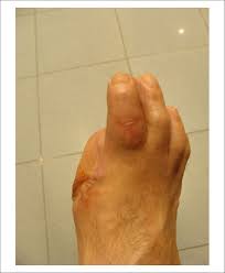 Image result for toe amputation