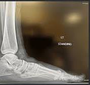 Case Study: All-Natural Flatfoot Reconstruction with Metal ...