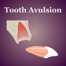 Image result for Tooth Avulsion