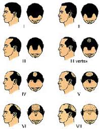 From developing secondary sexual characteristics, stimulating sex drive, to strengthening body muscles, it serves a slew of purposes. Mens Hair Restoration Los Angeles Dr Sean Behnam
