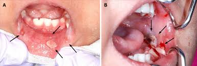 Image result for granuloma gum disease