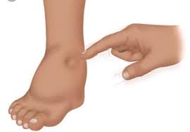 Check spelling or type a new query. Dr Rafidah Abdullah On Twitter Kalau Kaki Bengkak Begini Elok Periksa Mungkin Masalah Jantung Buah Pinggang Atau Hati Ni Dipanggil Oedema Bukan Gemok Air Medtweetmy Https T Co Rwigigqhwo