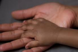 Image result for sickle cell symptoms